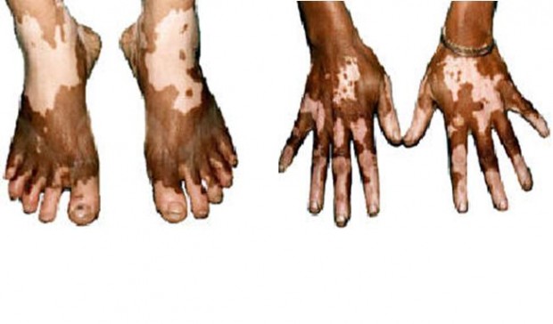 اطلاعاتی درباره برجس یا لک و پیس