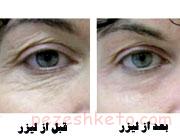 لیزر فراکشنال