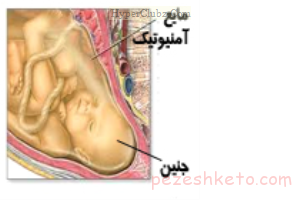 کاهش مایع دور جنین