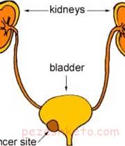 درمان سرطان مثانه