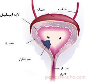 اطلاعاتی درباره نوار مثانه