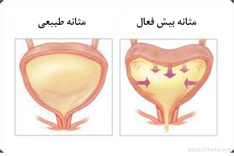 مثانه بیش فعال چیست