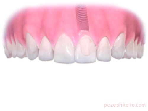 مراقب از دندان مصنوعی