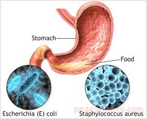 مسمومیت غذایی چیست