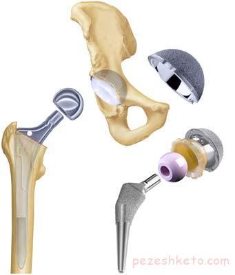 تعویض مفصل لگن