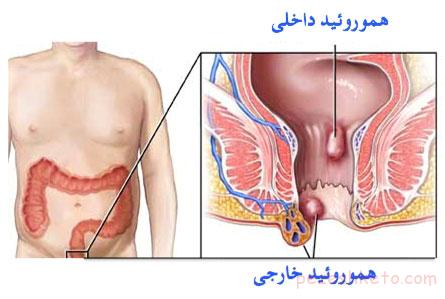 دلایل خونریزی از مقعد