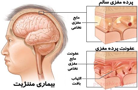 مننژیت در کودکان چیست