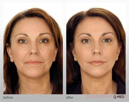 میکرودرم ابریژن