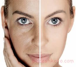 میکرونیدلینگ