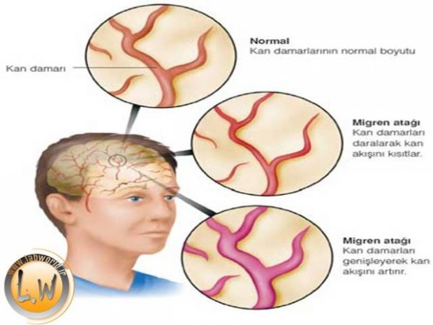 مقاله درباره سردردهای میگرن
