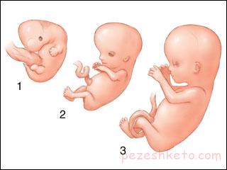 میگرن در بارداری