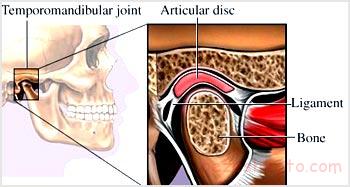 نشانگان‌ مفصل‌ گيجگاهی - فک تحتانی