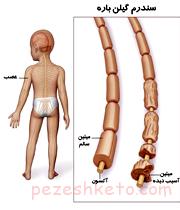 نشانگان‌ گيلن‌ باره‌ چیست