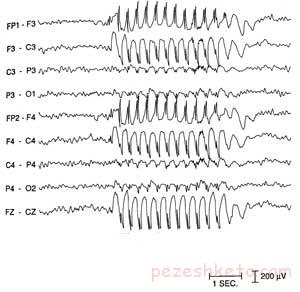 همی فاسیال اسپاسم