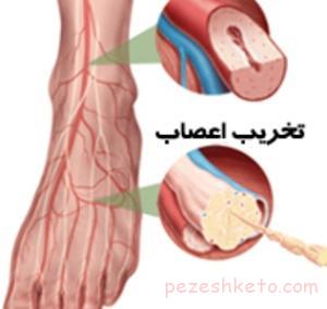 نوروپاتی چیست