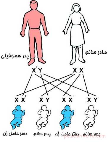 چطور از کودک هموفیلی مراقبت کنیم