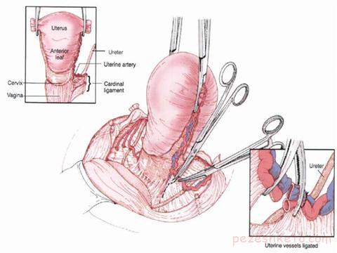 هیسترکتومی یا برداشتن رحم چیست
