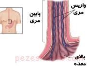 درمان واریس مری چگونه است