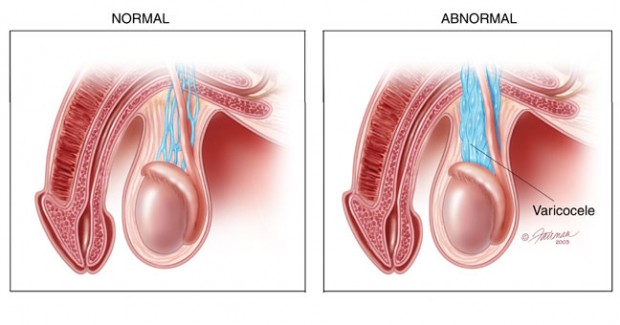 عوارض واریکوسل