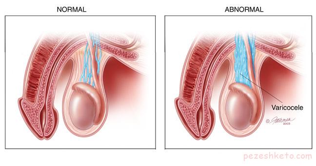 عوارض واریکوسل