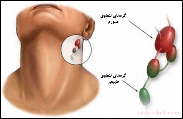 درمان غدد لنفاوی چیست