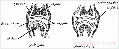ورم مفاصل یا آرتریت چیست