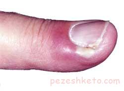 پارونیشیا یا عفونت اطراف ناخن چیست