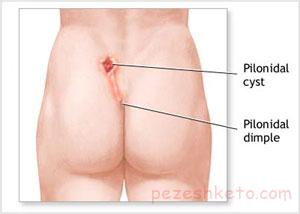 پايلونيدال