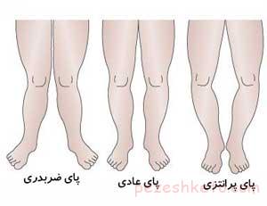 پای پرانتزی در کودکان