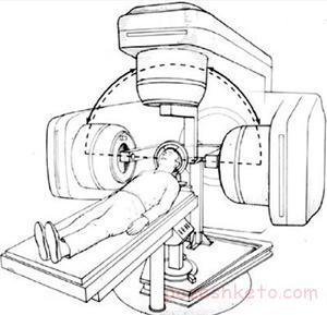 پرتو درمانی
