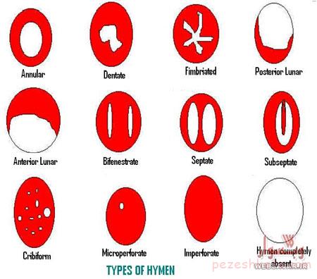 همه چیز درباره پرده بکارت