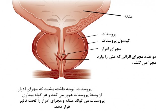عوارض جراحی پروستات
