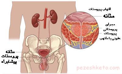 پروستاتیت یا التهاب پروستات
