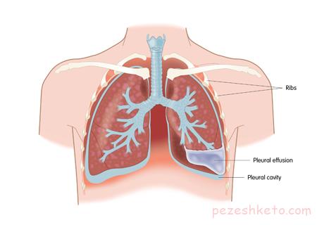 پلورال افيوژن