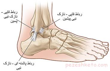 پیچ خوردگی مچ پا یا زانو
