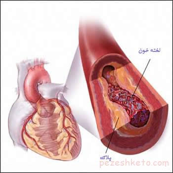 روشهای پیشگیری از بیماریهای قلبی