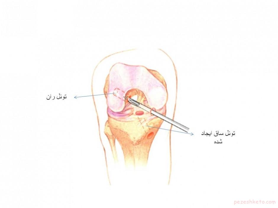 علائم عفونت در پین