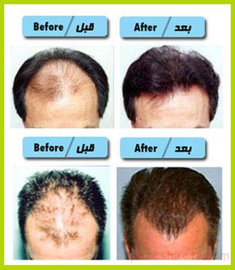 عوارض پیوند مو