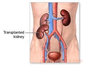 نکاتی برای بعد از پیوند کلیه