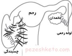 عوارض چسبندگی رحم چیست