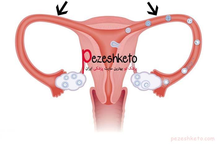 چسبندگی لوله های رحم چیست