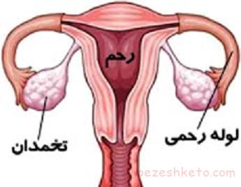 چسبندگی لوله های رحمی