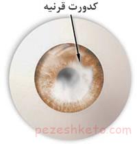 کدورت قرنیه چیست