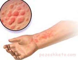 مقاله درباره کهیر