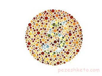 معرفی چند بیماری چشم