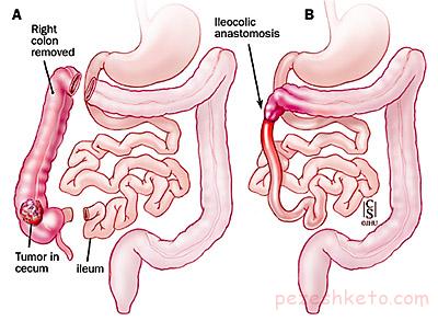 کولکتومی چیست