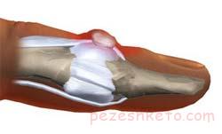 کیست موکوسی انگشت